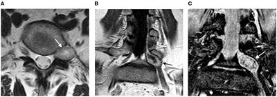 Percutaneous Transforaminal Full-Endoscopic Removal of Neurinoma of the Fifth Lumbar Nerve Root With Intraoperative Neuromonitoring: A Case Report